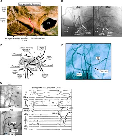 Catheter Ablation of Paroxysmal Supraventricular Tachycardia | Circulation