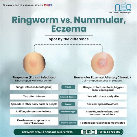 Nummular Eczema Vs Ringworm