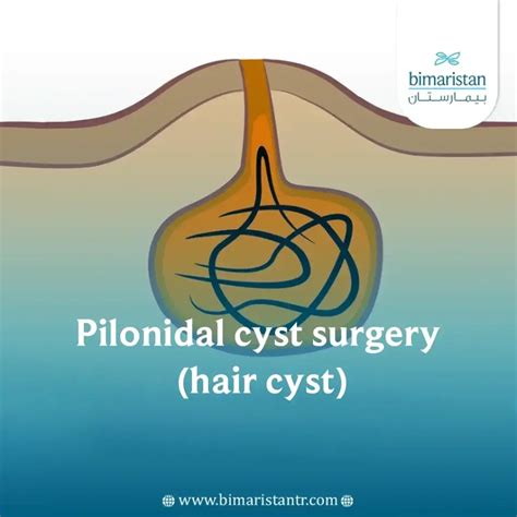Pilonidal Cyst