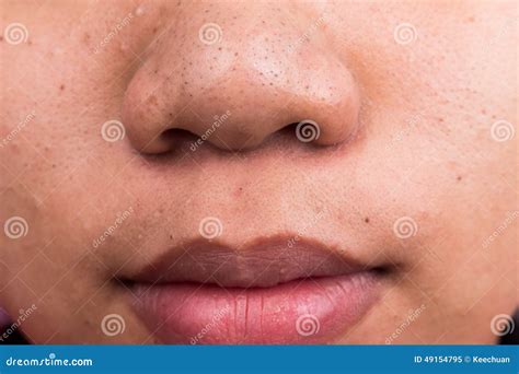 Pimple Blackheads on the Nose and Lips Stock Image - Image of face ...