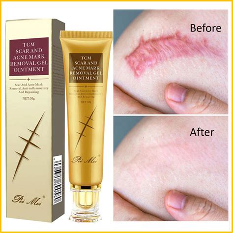 Acne Scar Removal Cream For Back at Maddison Pickworth blog