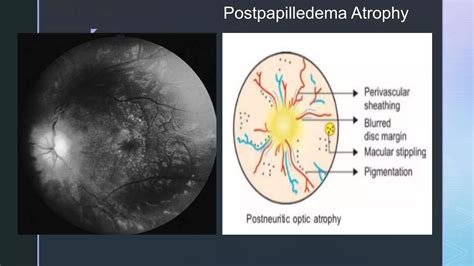 Papilledema - Optic Nerve Head Swelling | PPTX