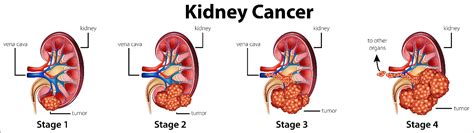 Breast And Kidney Cancer at Christopher Pettway blog