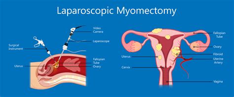 Myomectomy Surgery Melbourne » Fibroids Removal — A/Prof Alex Ades
