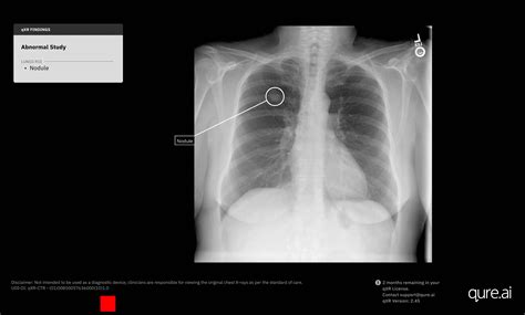 Abnormal Chest Xray Time To Embrace X Ray AI For Early Lung Cancer