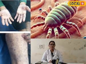 Scabies Prevention: స్కాబిస్ వ్యాధి అంటే ఏమిటీ..? దాని చికిత్స పూర్తి ...