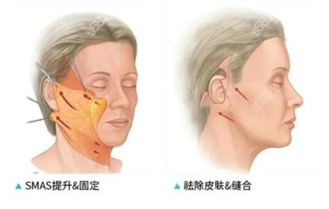 卢九宁拉皮怎么样？医生口碑好不好？拉皮效果怎么样？-三元整形网