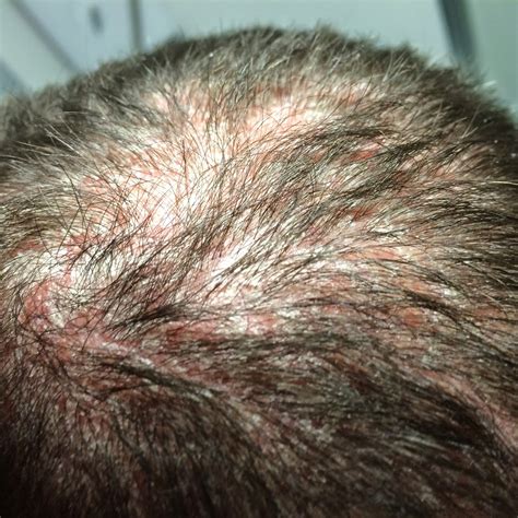 My pityriasis rubra pilaris blog: Scalp update