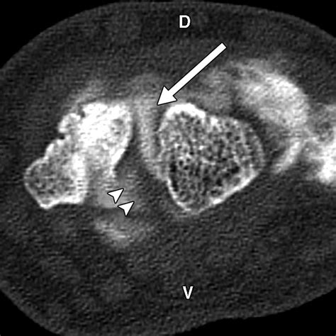 Scapholunate Advanced Collapse and Scaphoid Nonunion Advanced Collapse: MDCT Arthrography ...