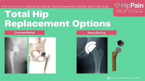 Hip replacement surgery: best materials and procedures - Hip Pain Help