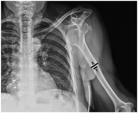 The Impact of the Position of the Humeral Head Relative to the Glenoid ...