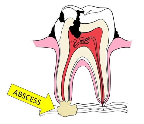 Image result for Abscessed Tooth Explosion