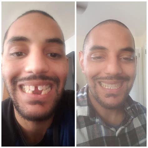 I Got Braces at 60 Years Old, and My Smile’s Never Looked Better Vector Art