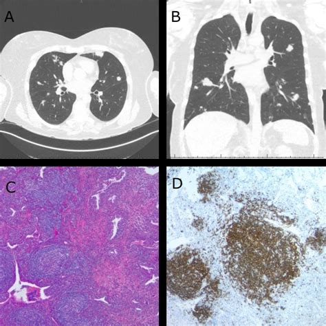 Pulmonary Nodule – Pulmonary Nodule Diagnosis – EFHEC