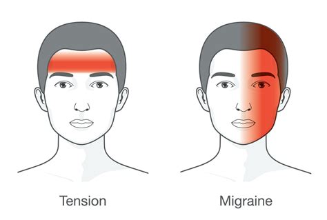 Where Do Tension Headaches Hurt Migraines And Tension Headaches