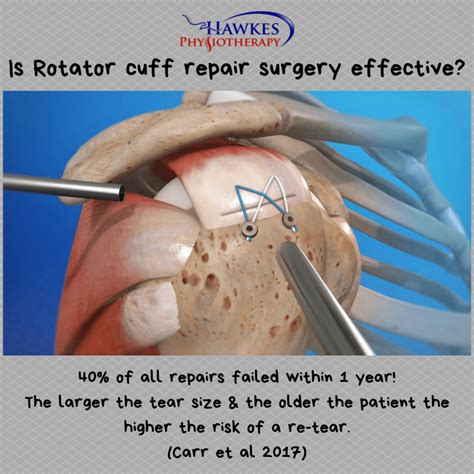 Rotator Cuff Surgery Cost Philippines at Savannah Cawthorne blog