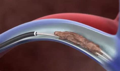 Alarmingly low rates of lead extraction in patients with implanted ...