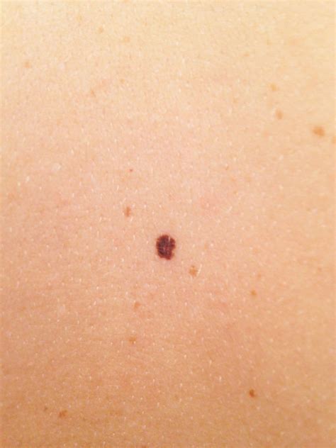 Signs of Skin Cancer: This Skin Check Can Save Your Life - Glamour