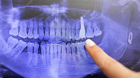 Digital dental panoramic radiograph taken with xray of a patient's mouth showing dental implant ...