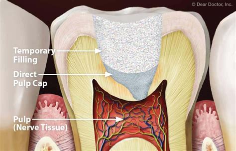 Image result for Direct Pulp Capping Vs RCT