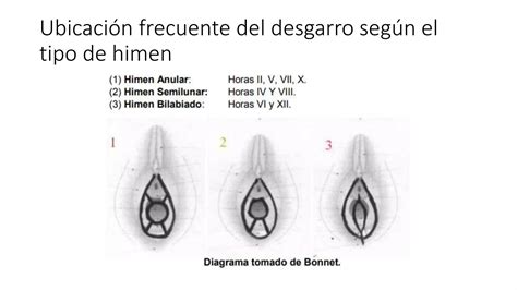Tipos-de-Desgarros-Himeneal.pptx