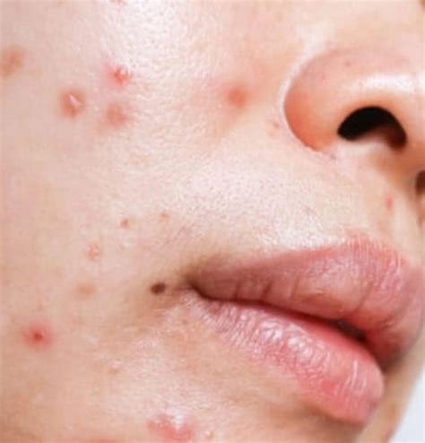 Image result for Sebaceous Cyst Removal Procedure