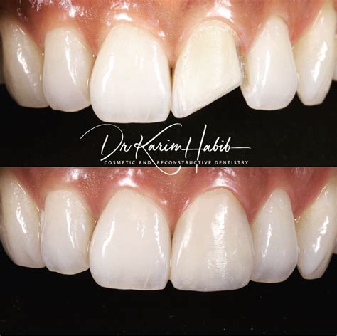 Composite Veneers Sydney | Dental Bonding Sydney - Dentist Ryde | Gladesville | Putney | North Ryde