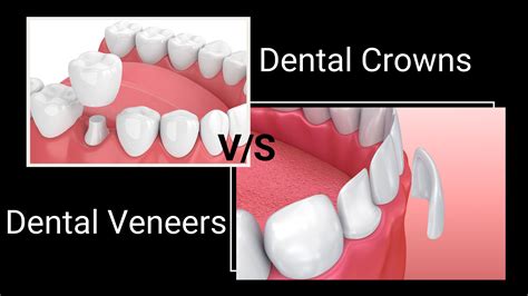 Difference between dental crown and veneer - Family Dentistry on Brock