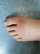 Image result for 脚癣 Foot's Ringworm