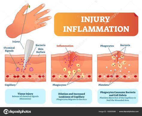 Image result for Inflammation Reaction