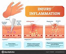inflammation 的图像结果
