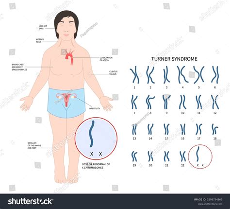 Turner Syndrome