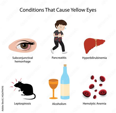 illustration of medical and biology, Conditions that cause yellow eyes ...