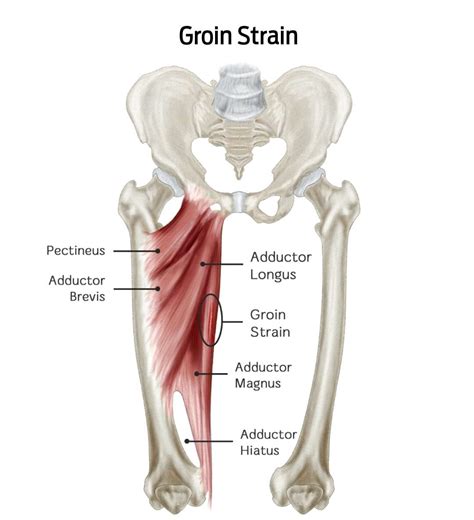Understanding Groin Strains: Injuries, Symptoms, & Treatments ...