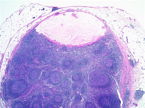Kuvatulokset haulle pericolonic lymph nodes