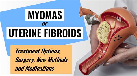 Uterine Fibroids: Treatment Options, Surgery, New Methods | SurgMedia