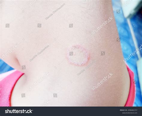Child Worm Infections Images: Browse 159 Stock Photos & Vectors Free Download with Trial ... - how small is ringworm