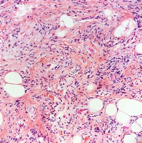 Spindle Cell Lesion Pathology Outlines at Jon Lefebre blog