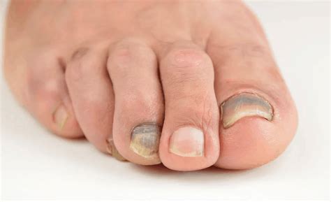 Suffering With Dark Spots Under Your Toenails? | Treatments