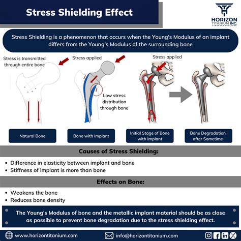 Titanium Stress Shielding Effect Image: Watch It In Action