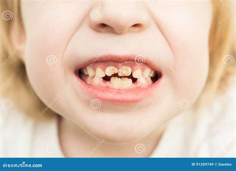 Bad teeth stock image. Image of people, fell, rotten - 91209749