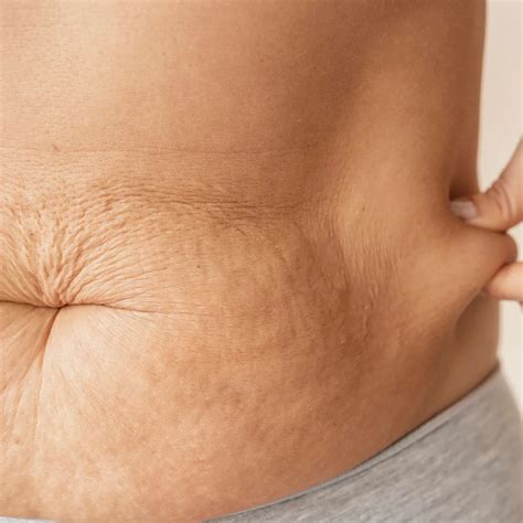 Stretch Marks During Pregnancy | Causes and Skin Management | Uncover ...