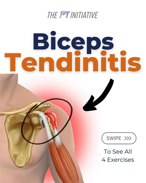 Biceps Tendonitis Exercises Pdf