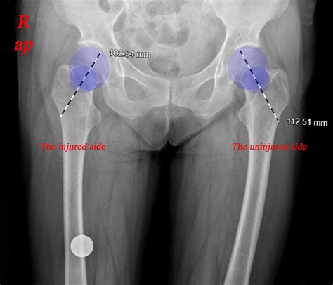 “In‐Out‐In” Percutaneous Reduction Technique for Treatment of Valgus ...