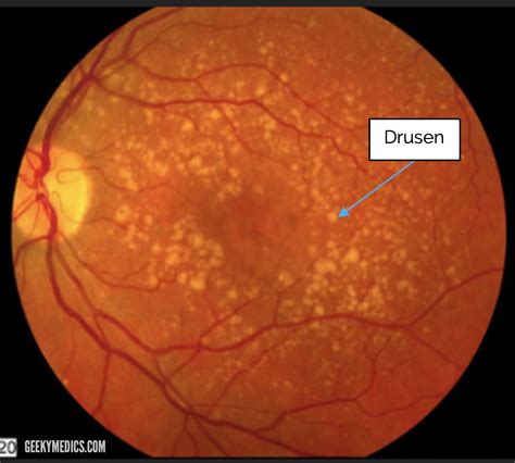 Fundoscopic Appearances of Retinal Pathologies | Geeky Medics