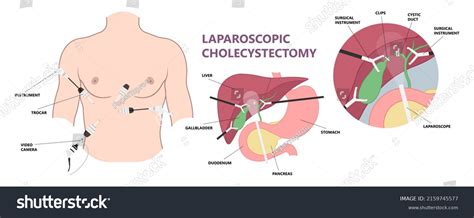 Open Cholecystectomy 的图像结果