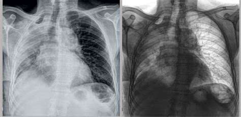 Atelektasis - Gejala, Penyebab, dan Pengobatan - Alodokter
