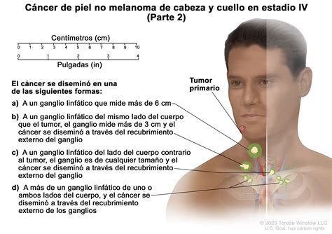 Tratamiento del cáncer de piel - NCI