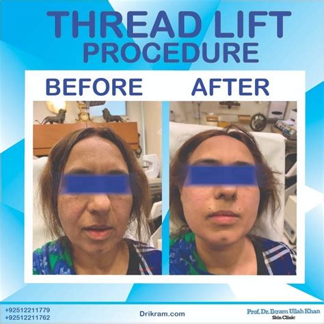 Image result for Thread Lift Procedure YouTube