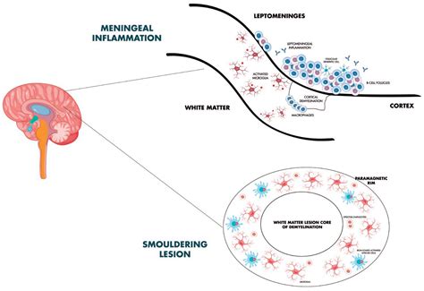 A Window to New Insights on Progression Independent of Relapse Activity ...